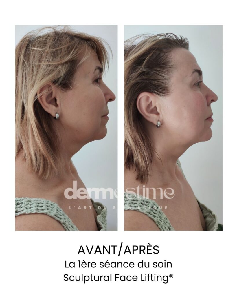 Avant après sillons nasogéniens face sculpting sculptural face lifting facialiste Nice